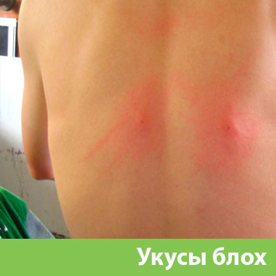 Укусы блох в Ржеве