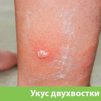 Укус двухвостки в Ржеве