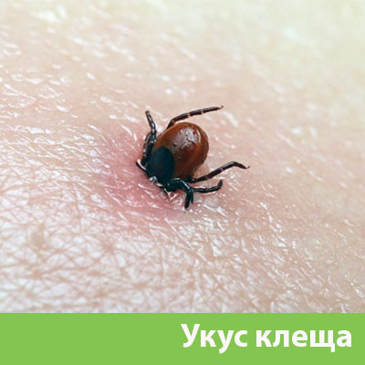 Укус клеща в Ржеве